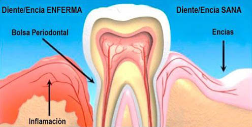 Tratamiento de periodoncia